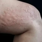 Coceira e Bolhas na Pele: Entenda a Urticária e Quando Procurar Ajuda Imagem da página de origem