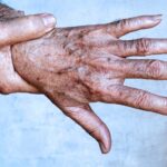 A falta desse mineral está provocando manchas de idade na sua pele Imagem da página de origem