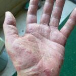 Sinais Reveladores nas Mãos: O Que Significam Manchas e Colorações featured-1785978225383