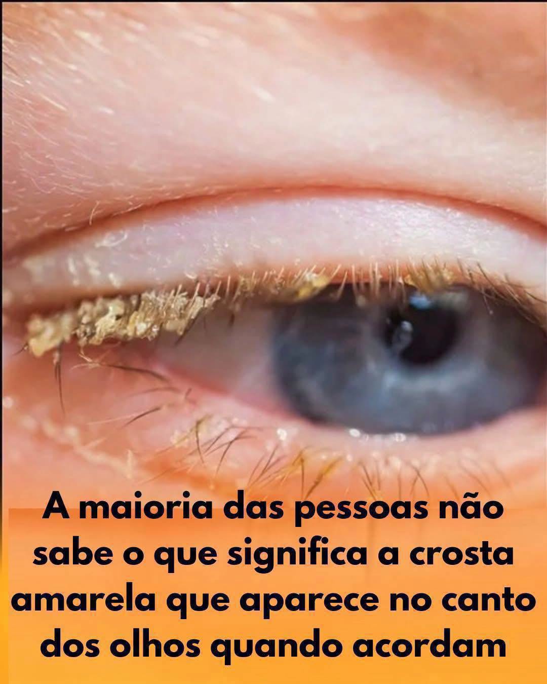 Ramela nos Olhos: O que a crosta amarela revela?